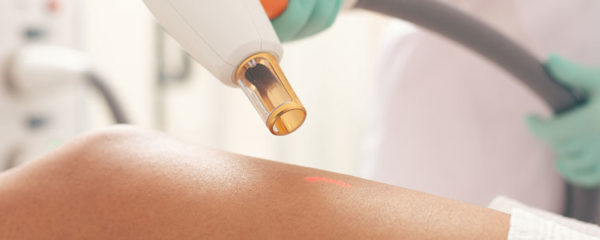 epilation laser lyon