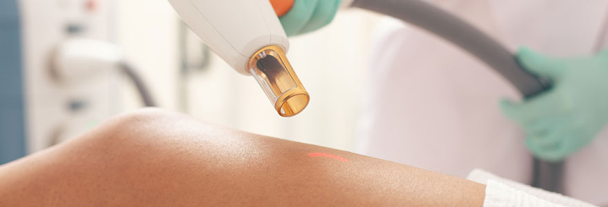 epilation laser lyon