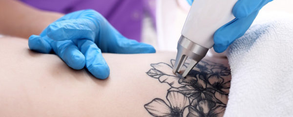détatouage
